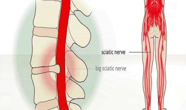 Nguyên nhân gây đau thần kinh tọa