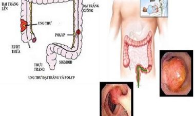 Nội soi đại tràng có đau không?