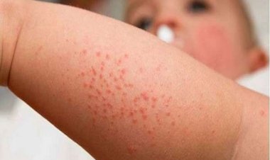 Cách trị rôm sảy cho trẻ bằng mướp đắng và lưu ý