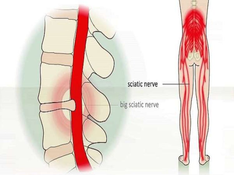 Nguyên nhân gây đau thần kinh tọa