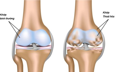 4 bệnh cơ xương khớp thường gặp