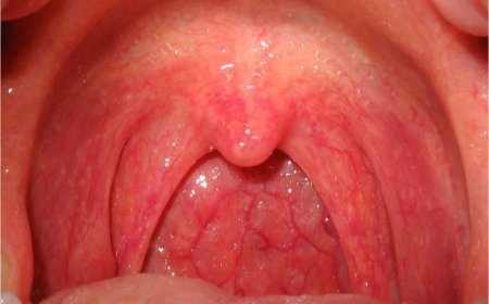 Bệnh viêm họng và nguyên nhân