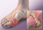 Bệnh gút là gì? Nguyên nhân và triệu chứng