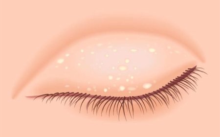 Mụn hạt kê: Nguyên nhân và cách loại bỏ