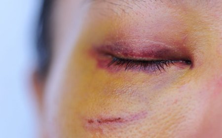 Cách điều trị và ngăn ngừa mắt thâm tím và bầm tím xung quanh mắt