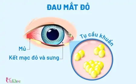 Bệnh đau mắt đỏ là gì? Dấu hiệu, nguyên nhân và lưu ý