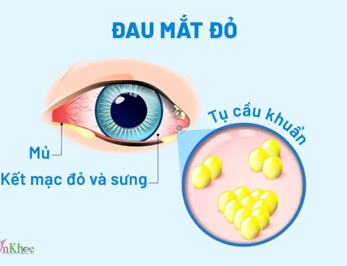 Bệnh đau mắt đỏ là gì? Dấu hiệu, nguyên nhân và lưu ý